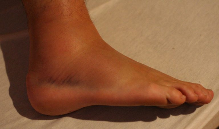 pictures of swollen ankles due to kidney problems